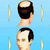 Gesundheit: So Lässt Sich Haarausfall Aufhalten - Welt ganzes Wieviel Haare Hat Der Mensch Auf Dem Kopf
