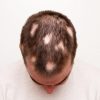 Kahle Stellen Am Kopf: Alles Zu Kreisrundem Haarausfall bei Wie Viele Haare Hat Man Auf Dem Kopf