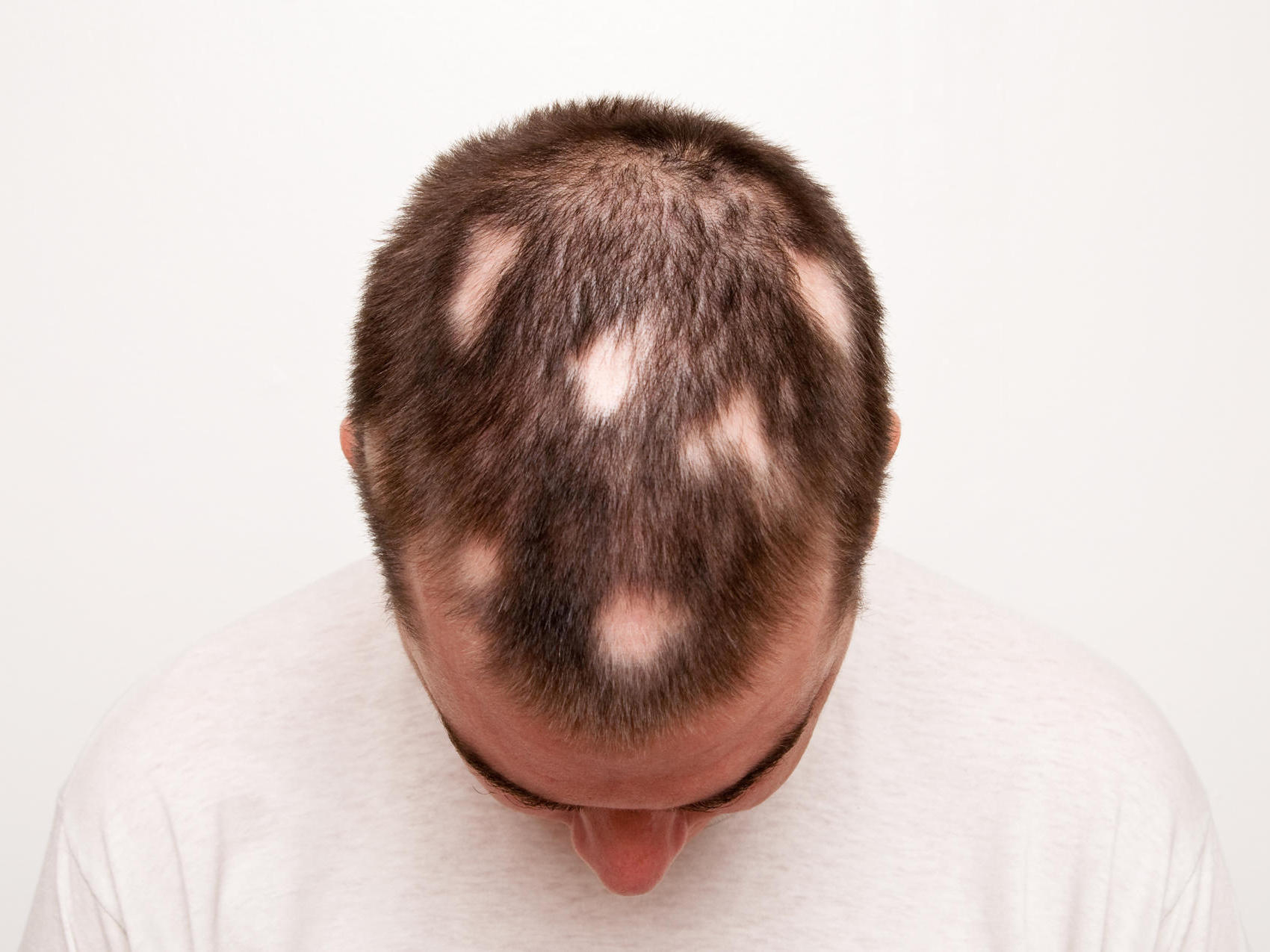 Kahle Stellen Am Kopf: Alles Zu Kreisrundem Haarausfall bei Wie Viele Haare Hat Man Auf Dem Kopf