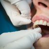 Lücken In Der Versorgung - Vermischtes Aus Deutschland über Alle Zähne Ziehen Unter Vollnarkose