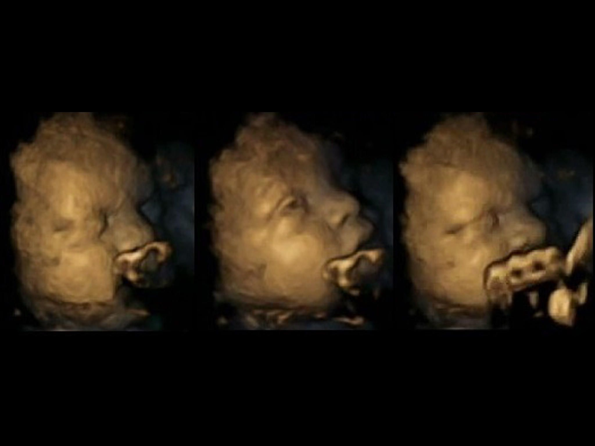 Rauchen In Der Schwangerschaft: Ultraschall-Bilder Zeigen innen Was Passiert Beim Rauchen In Der Schwangerschaft