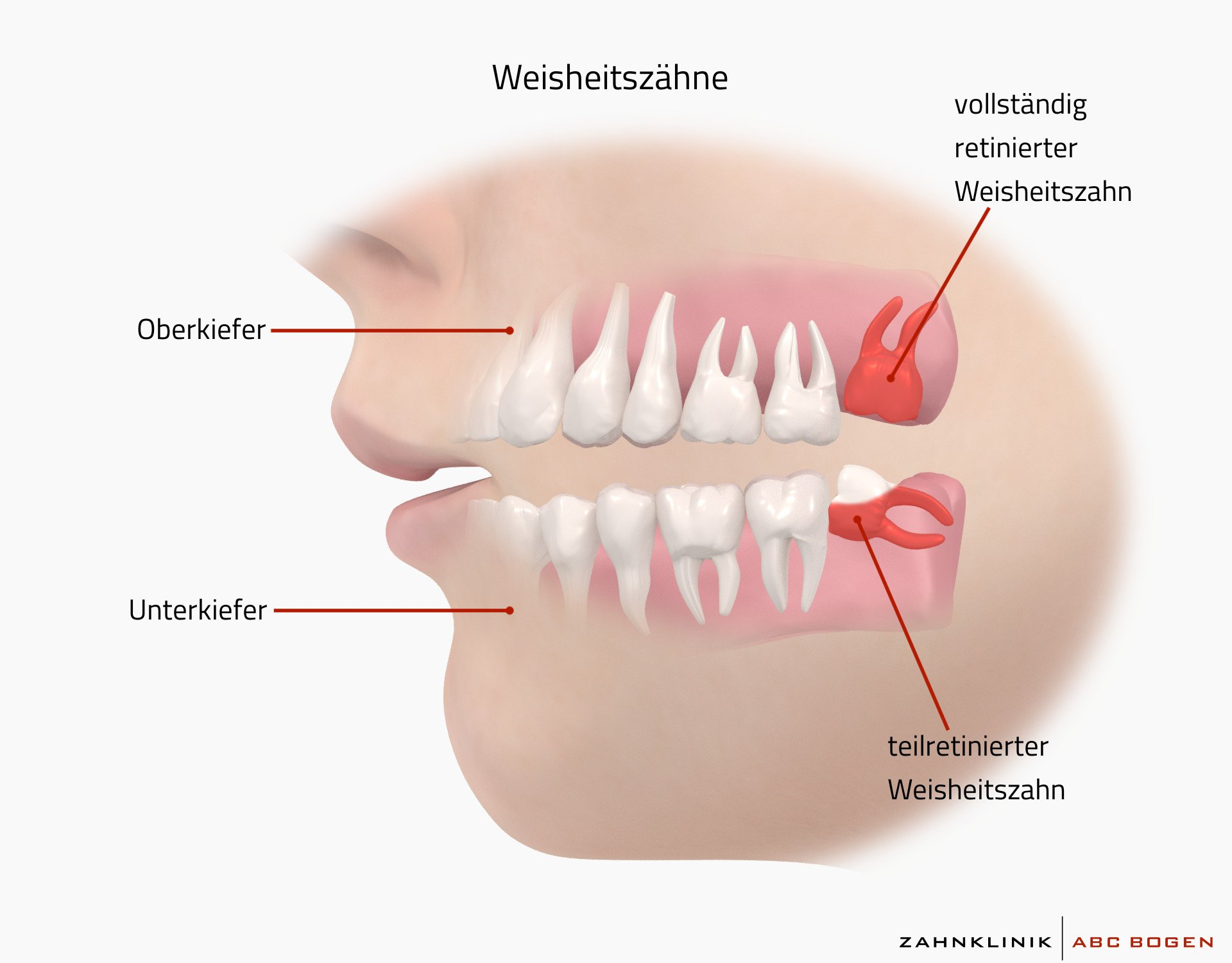 Weisheits-) Zahnentfernung Und Op In Hamburg - Zahnklinik für Alle Zähne Ziehen Unter Vollnarkose
