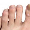 20+ Latest Nagelpilz Oder Schuppenflechte - Affauto bestimmt für Erkennen Fußpilz Kinder Bilder
