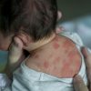 31 Best Pictures Ringelröteln Wann Ansteckend über Milben Hautausschlag Bilder Kinder
