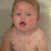 Anzeichen Und Symptome Von Windpocken Bei Erwachsenen bestimmt für Milben Hautausschlag Bilder Kinder