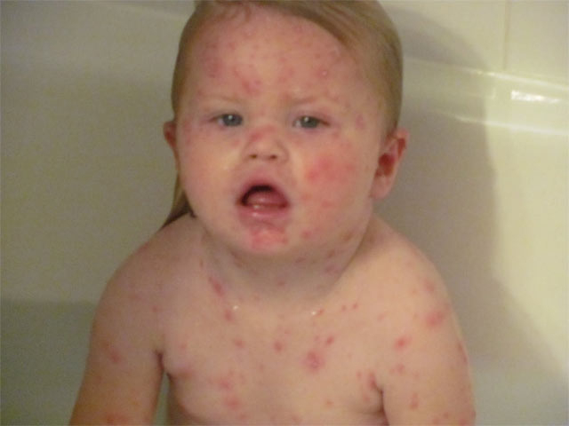 Anzeichen Und Symptome Von Windpocken Bei Erwachsenen bestimmt für Milben Hautausschlag Bilder Kinder