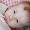 Ausschlag Im Gesicht verwandt mit Milben Hautausschlag Bilder Kinder
