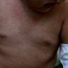 Drei-Tage-Fieber bei Hautausschlag Kinder Bilder