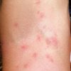 Eichenprozessionsspinner-Allergie - Ursachen, Symptome ganzes Hautausschlag Kinder Bilder