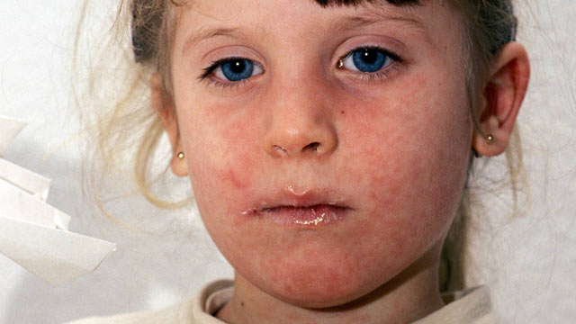 Fakten: Masern Sind Keine Harmlose Kinderkrankheit in Eichenprozessionsspinner Ausschlag Kinder Bilder