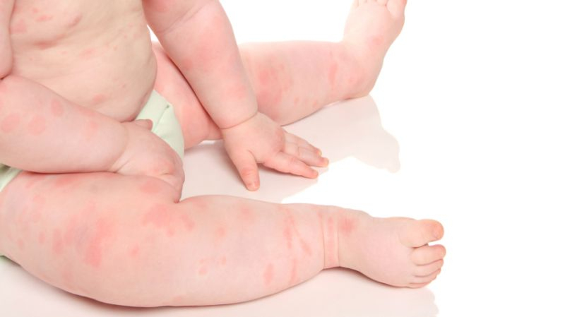 Hautausschlag Baby Ganzer Korper - Ganzer 2020 verwandt mit Nesselsucht Kinder Bilder