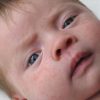 Ihr Kind Hat Neurodermitis Oder Einen Anderen Ausschlag in Eichenprozessionsspinner Ausschlag Kinder Bilder