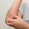 Juckender Hautausschlag: Mögliche Ursachen Und Behandlung bei Milben Hautausschlag Bilder Kinder