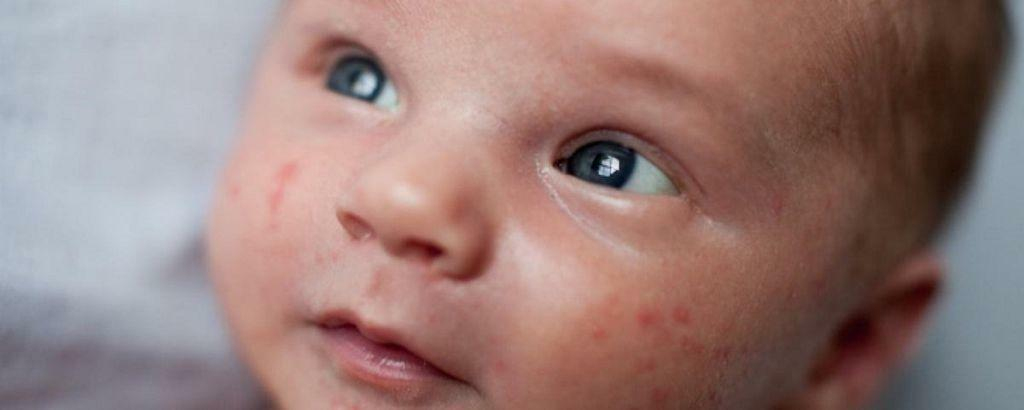 Kinderkrankheiten Mit Ausschlägen Auf Der Haut bestimmt für Eichenprozessionsspinner Ausschlag Kinder Bilder