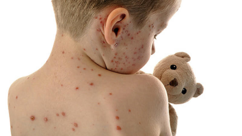 Masern, Mumps Oder Röteln: Kinderkrankheiten Bloß Nicht verwandt mit Eichenprozessionsspinner Ausschlag Kinder Bilder