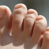 Nagelpilz - Welche Hausmittel Und Behandlungen Helfen? verwandt mit Erkennen Fußpilz Kinder Bilder