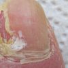 Nagelverformung - Deformierte Nägel Durch Verletzung Oder verwandt mit Erkennen Fußpilz Kinder Bilder
