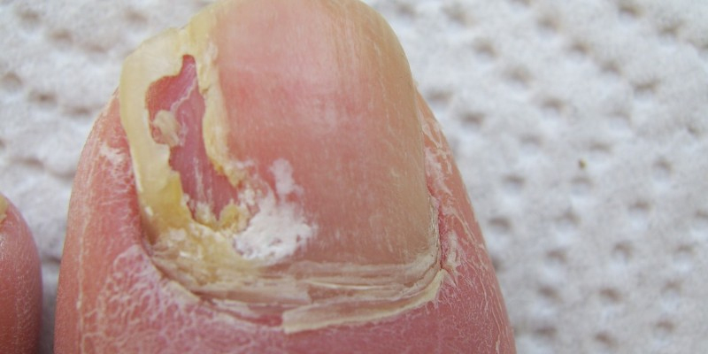 Nagelverformung - Deformierte Nägel Durch Verletzung Oder verwandt mit Erkennen Fußpilz Kinder Bilder
