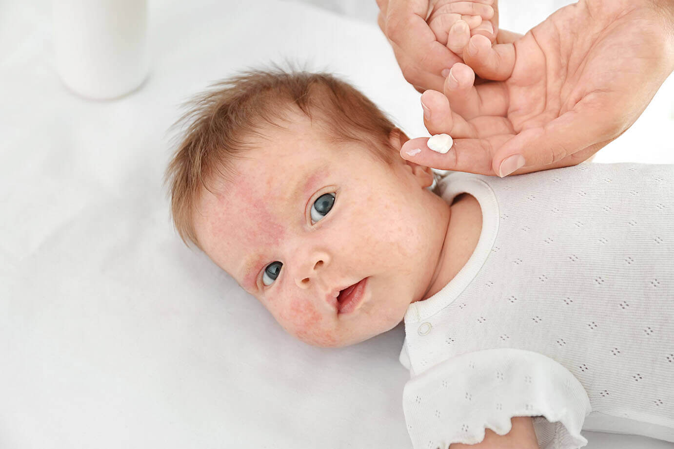 Neurodermitis Beim Baby - Symptome, Ursachen &amp; Behandlung innen Neurodermitis Kinder Bilder