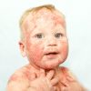 Neurodermitis - Ursachen, Naturheilkunde Und Therapie für Milben Hautausschlag Bilder Kinder