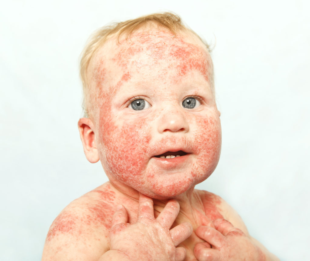 Neurodermitis - Ursachen, Naturheilkunde Und Therapie für Milben Hautausschlag Bilder Kinder