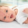 Neurodermitis: Vorsicht Bei Krusten Und Bläschen für Neurodermitis Kinder Bilder