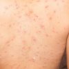 Papeln: Symptome, Ursachen Und Behandlung - Heilpraxis innen Milben Hautausschlag Bilder Kinder
