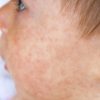 Röteln: Symptome Erkennen - Netdoktor ganzes Milben Hautausschlag Bilder Kinder