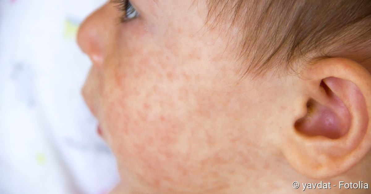 Röteln: Symptome Erkennen - Netdoktor ganzes Milben Hautausschlag Bilder Kinder