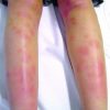 Was Steckt Eigentlich Hinter Hautrötungen Mit Fieber? verwandt mit Milben Hautausschlag Bilder Kinder