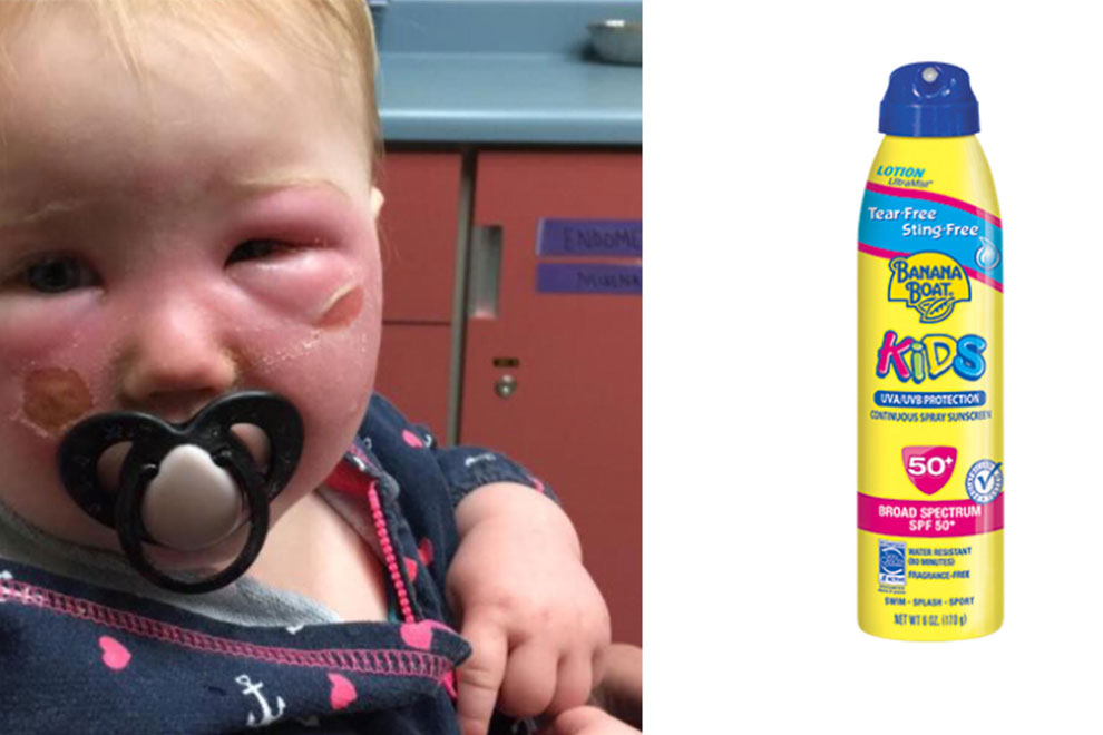 Achtung: Dieses Baby Trägt Verbrennungen Von Sonnencreme Davon bei Verbrennungen Kinder Bilder