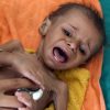 'Als Kind In Jemen Heb Je Geen Toekomst' ganzes Verhungernde Kinder Bilder