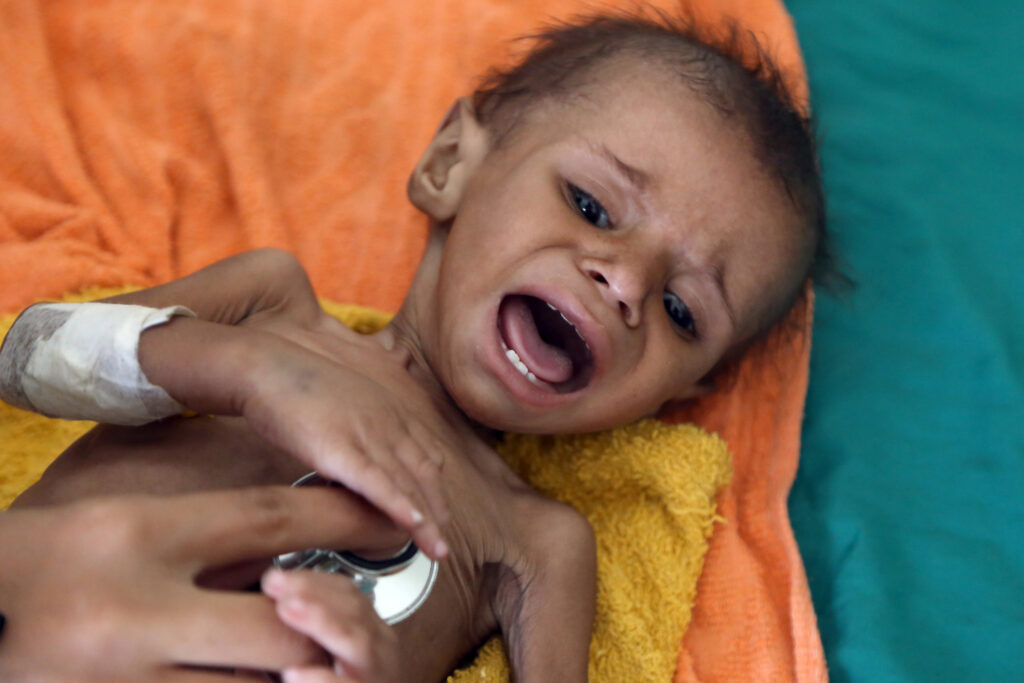 'Als Kind In Jemen Heb Je Geen Toekomst' ganzes Verhungernde Kinder Bilder