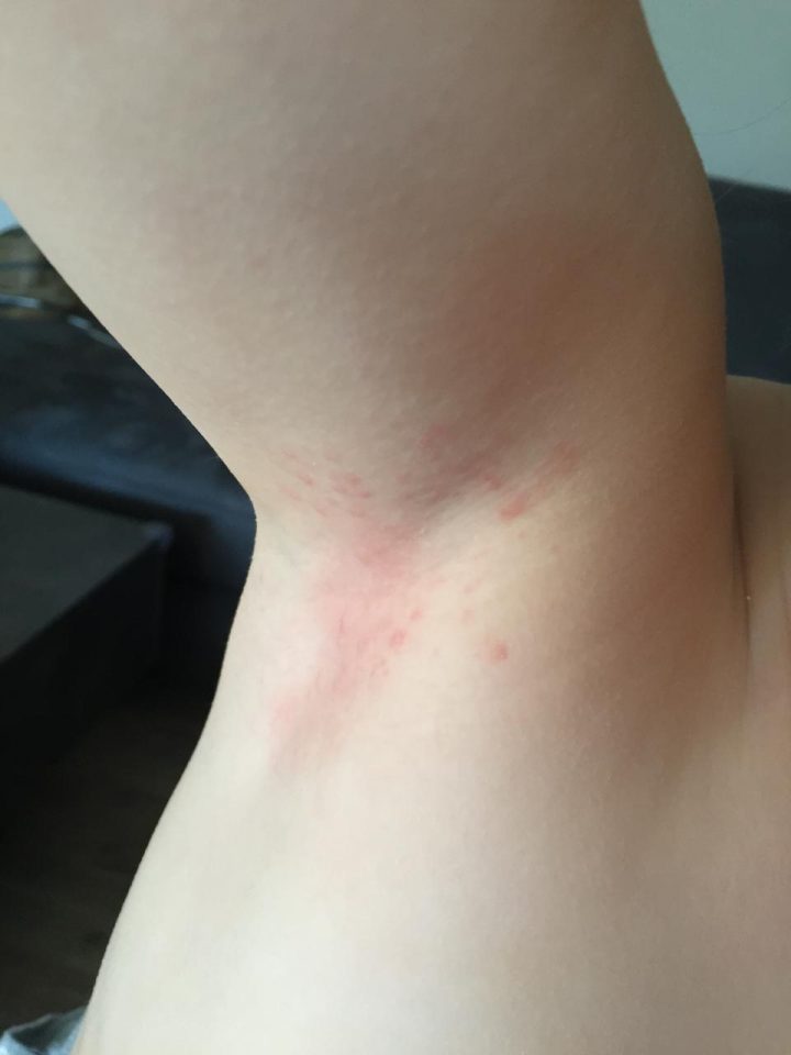 Ausschlag Bilder Bei Kindern innen Scharlach Kinder Bilder Ausschlag Bilder Bei Kindern innen Scharlach Kinder Bilder