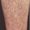Blaue Flecke An Den Beinen, Leukämie, Plötzlich, Hämatome, Körper über Kinder Hautkrankheiten Bilder