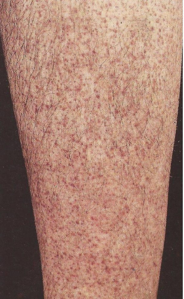 Blaue Flecke An Den Beinen, Leukämie, Plötzlich, Hämatome, Körper über Kinder Hautkrankheiten Bilder