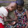 Das Mädchen Mit Einer Seltenen Genetischen Krankheit ganzes Progerie Kinder Bilder