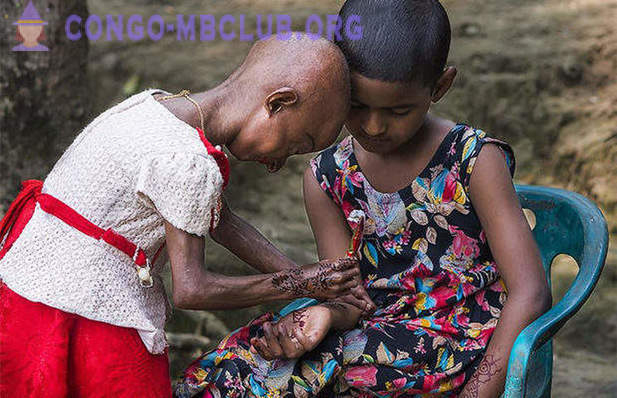 Das Mädchen Mit Einer Seltenen Genetischen Krankheit ganzes Progerie Kinder Bilder