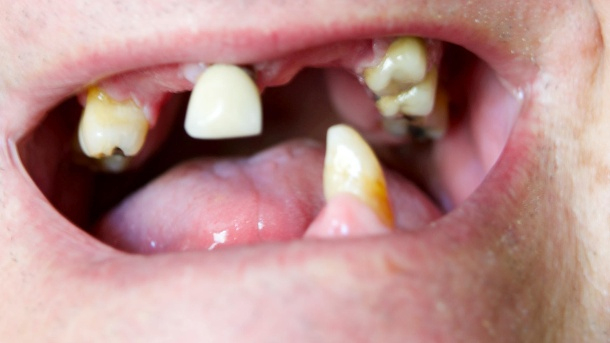 Demenzrisiko: Darum Schädigen Schlechte Zähne Ihr Gehirn bestimmt für Kinder Bilder Einschliesslich Machen Lassen