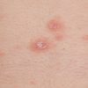 Dermatologie Bäumleingasse » Pityriasis Rosea Dr. Th verwandt mit Kinder Hautkrankheiten Bilder