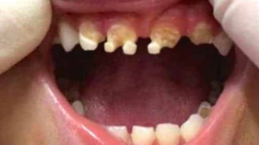 Dieses Kind Hat Vom Zucker Ganz Schlechte Zähne Bekommen! bestimmt für Kinder Bilder Einschliesslich Machen Lassen