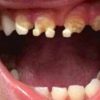 Dieses Kind Hat Vom Zucker Ganz Schlechte Zähne Bekommen! für Karies Zähne Kinder Bilder