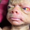 老人のように見える赤ん坊がバングラディッシュで生まれる für Progerie Kinder Bilder