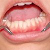 Engstand - Ursachen, Folgen Und Behandlung | Kieferorthopäde Kiel | Dr bestimmt für Faule Zähne Kinder Bilder