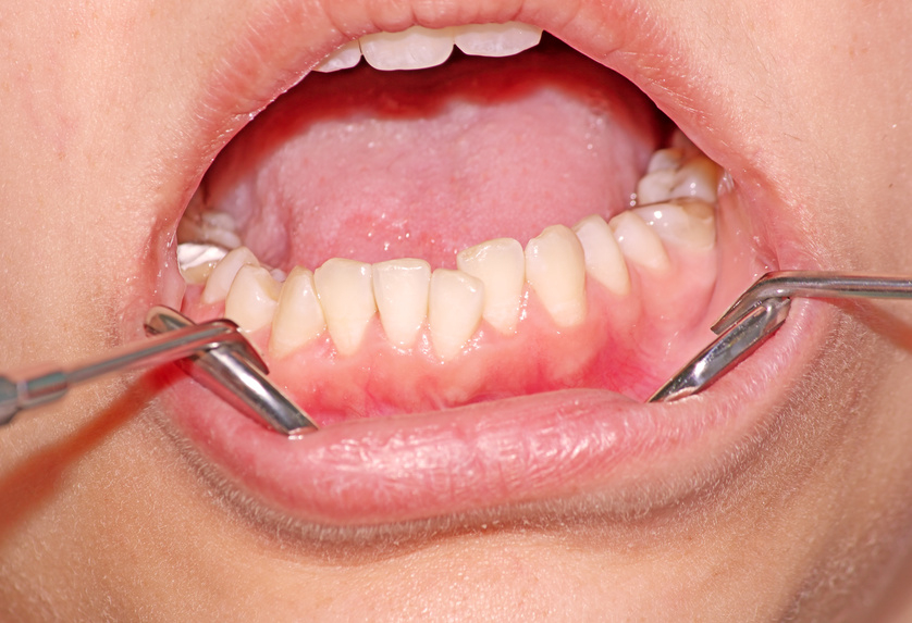 Engstand - Ursachen, Folgen Und Behandlung | Kieferorthopäde Kiel | Dr mit Karies Zähne Kinder Bilder