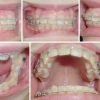 Feste Zahnspange | Adjami Orthodontics bestimmt für Zahnspange Kinder Bilder
