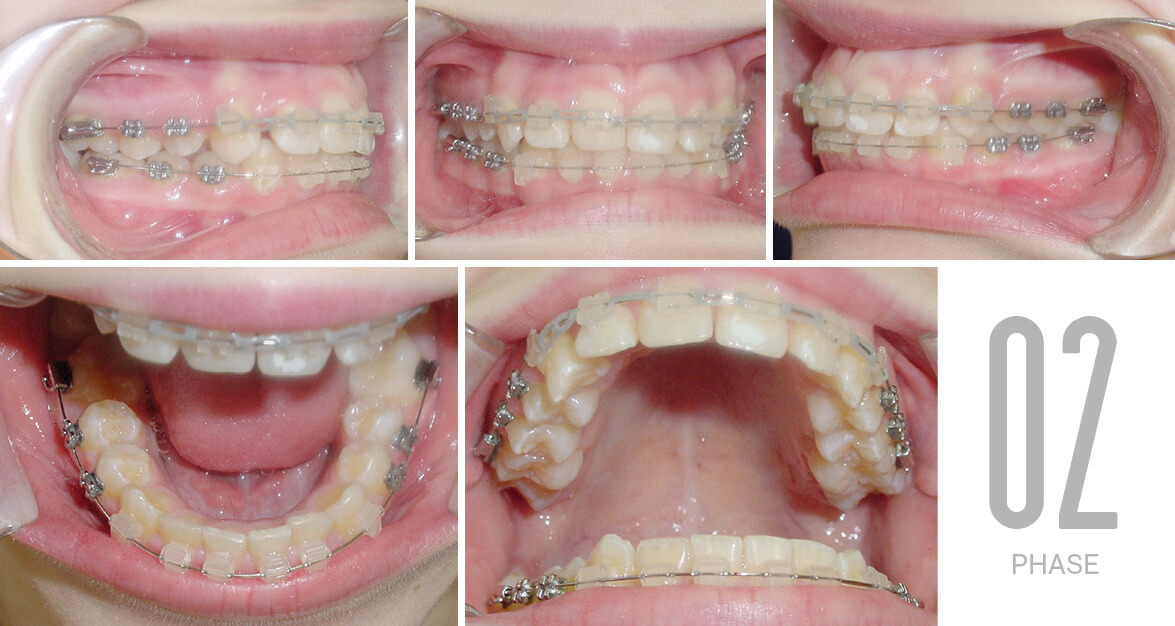Feste Zahnspange | Adjami Orthodontics bestimmt für Zahnspange Kinder Bilder