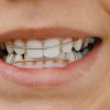 Ganzheitliche Kieferorthopädie Mit Dem Bionator in Zahnspange Kinder Bilder