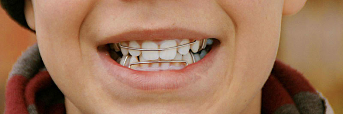 Ganzheitliche Kieferorthopädie Mit Dem Bionator in Zahnspange Kinder Bilder
