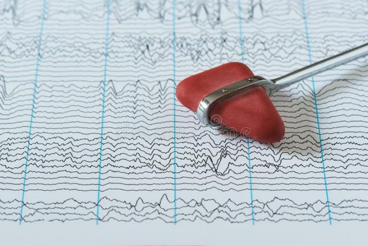 Gehirnwelle Auf Elektroenzephalogramm Eeg Stockbild - Bild Von bei Eeg Kinder Bilder